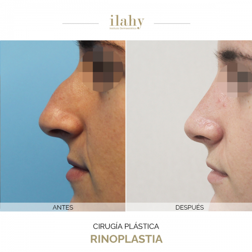 Rinoplastia - Caso Antes y Despu�s